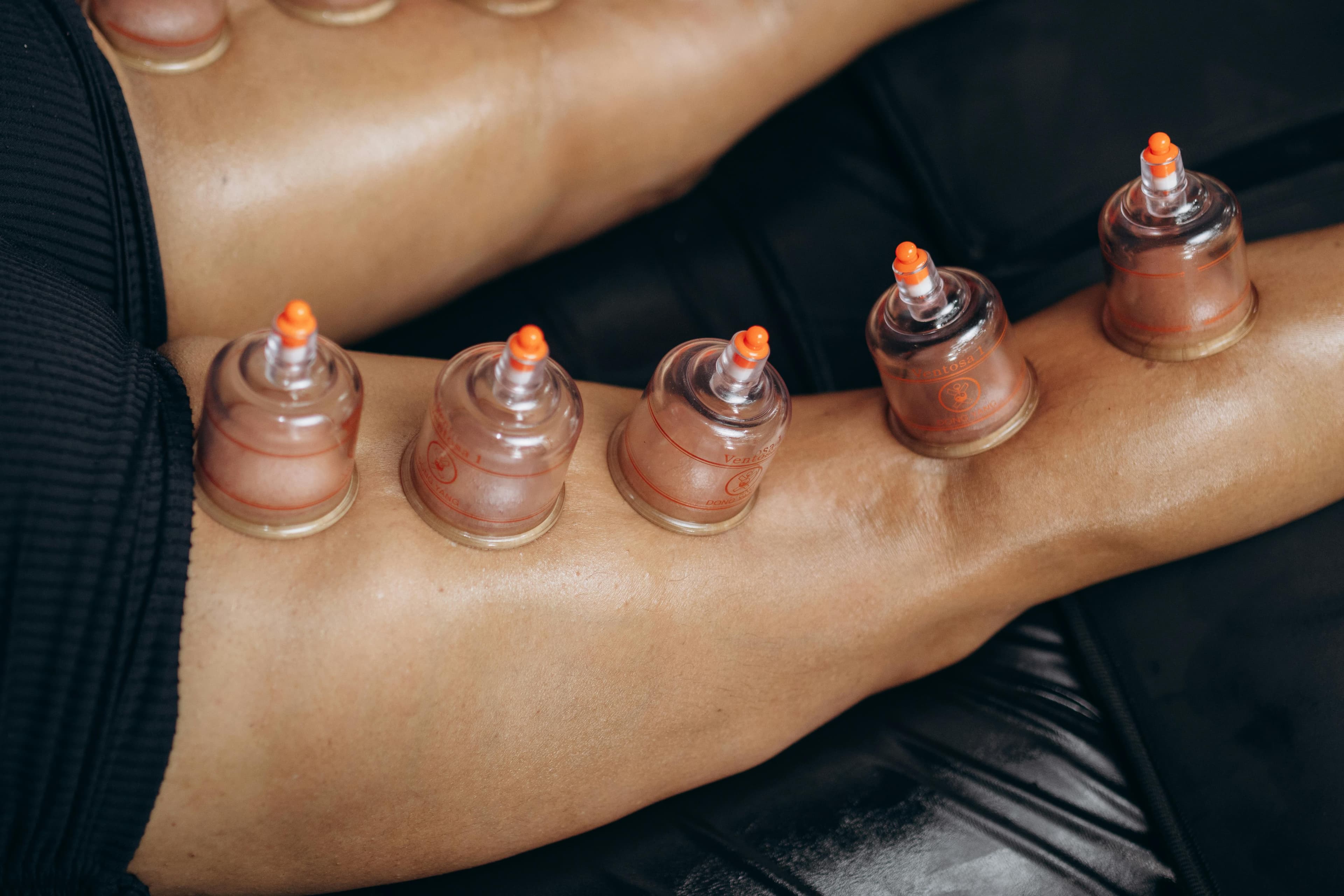 Cupping Therapy